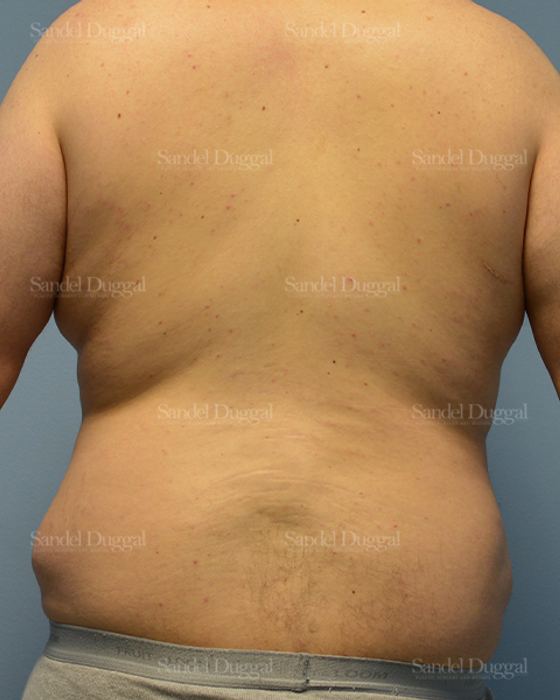 Liposuction — Legs & Flanks before, case 2545