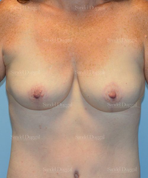 Breast Augmentation with Lift after, case 3365