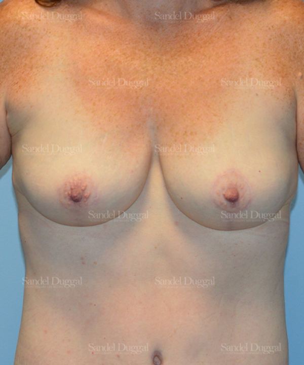 Breast Augmentation with Lift after, case 3365