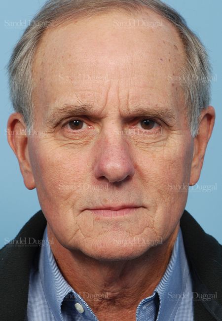 Facelift before, case 2654