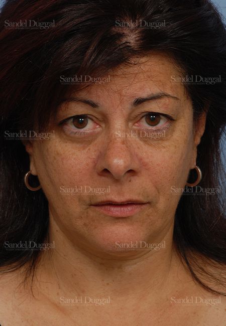Facelift before, case 2671