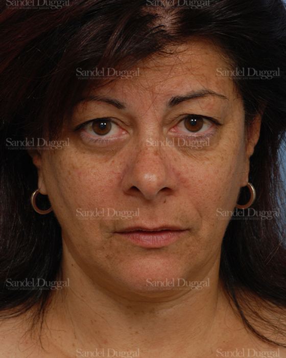 Facelift before, case 2671