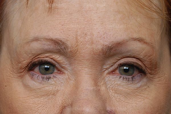 Eyelid Rejuvenation before, case 1930
