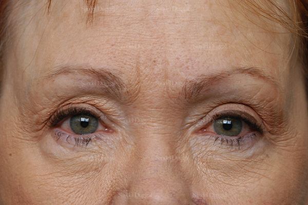 Eyelid Rejuvenation before, case 1930