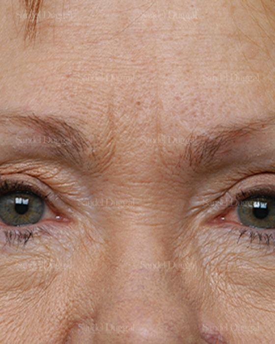 Eyelid Rejuvenation before, case 1930