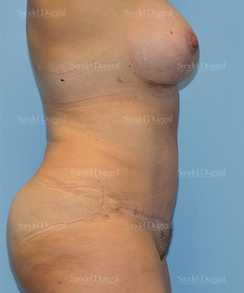 Tummy Tuck after, case 1694