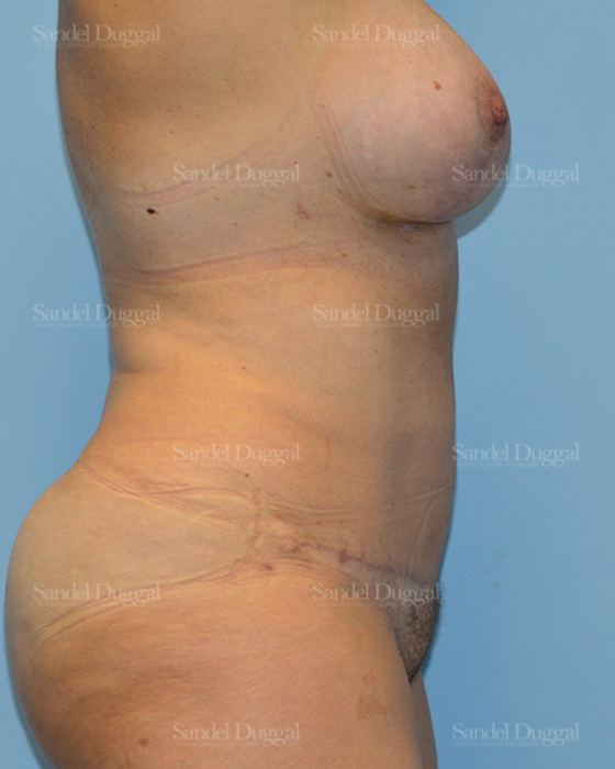 Tummy Tuck after, case 1694