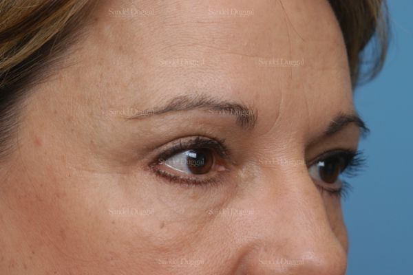 Forehead Lift after, case 2226