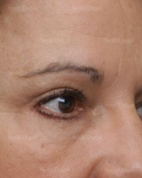 Forehead Lift after, case 2226