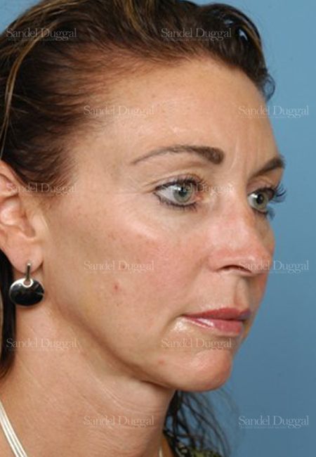 Rhinoplasty before, case 2906