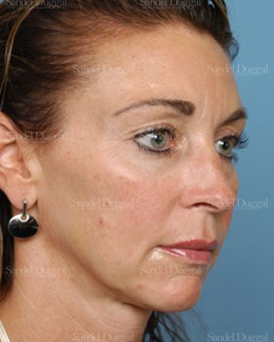 Rhinoplasty before, case 2906