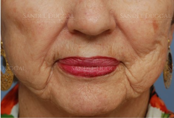 Lower Lip Advancement after