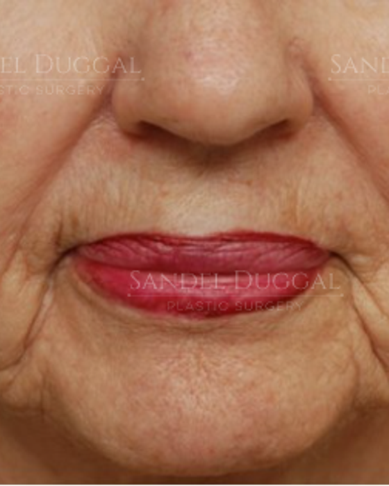 Lower Lip Advancement after, case LLA-1