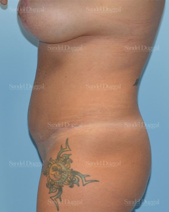 Tummy Tuck after, case 1559