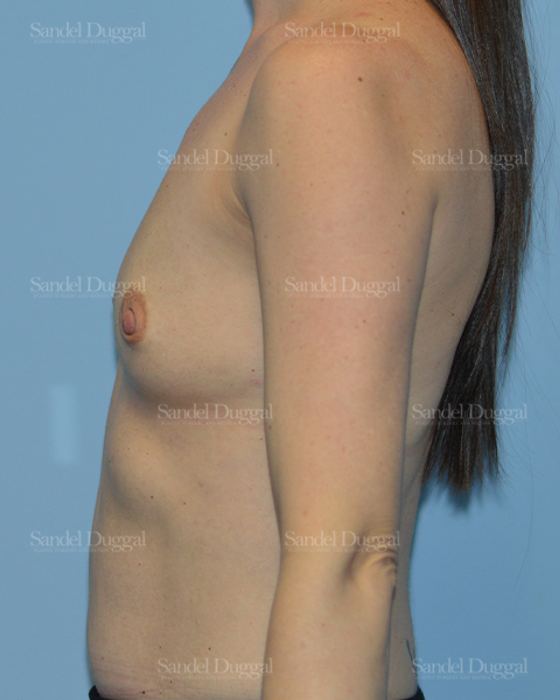 Breast Augmentation before, case 3178