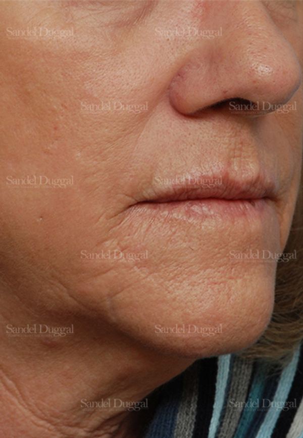 Laser Skin Resurfacing before, case 2932