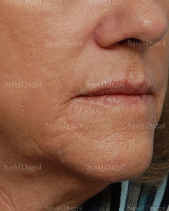 Laser Skin Resurfacing before, case 2932