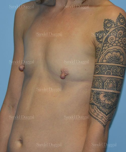 Breast Augmentation before, case 3136