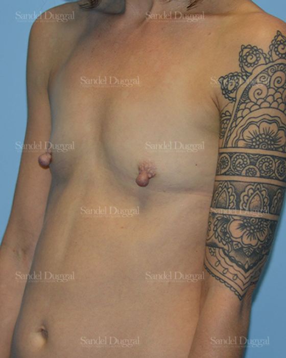 Breast Augmentation before, case 3136