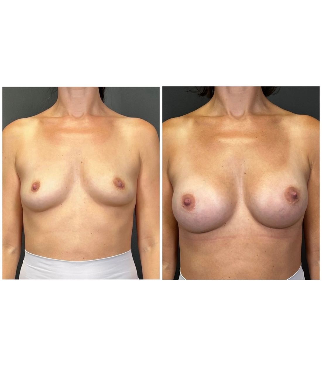 Motiva Preserve before and after, case preserve-02