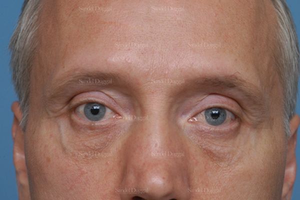Revision Rhinoplasty before, case 2609