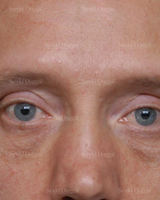 Revision Rhinoplasty before, case 2609
