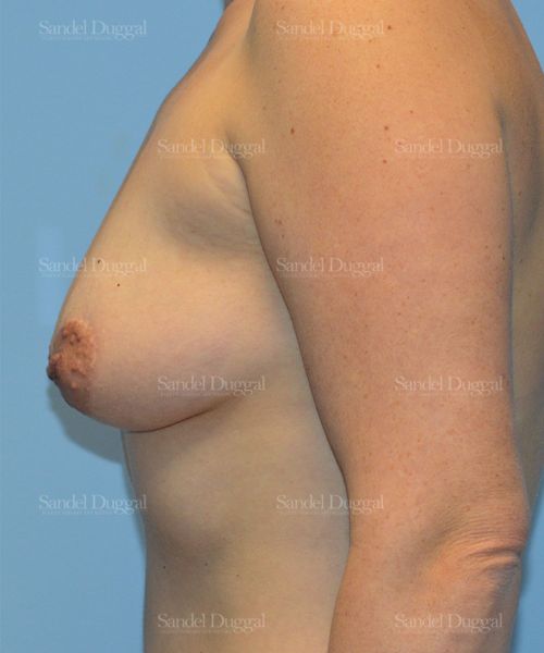 Breast Augmentation with Lift before, case 3456