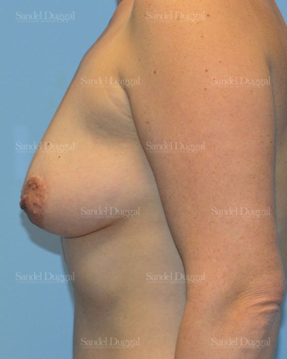 Breast Augmentation with Lift before, case 3456