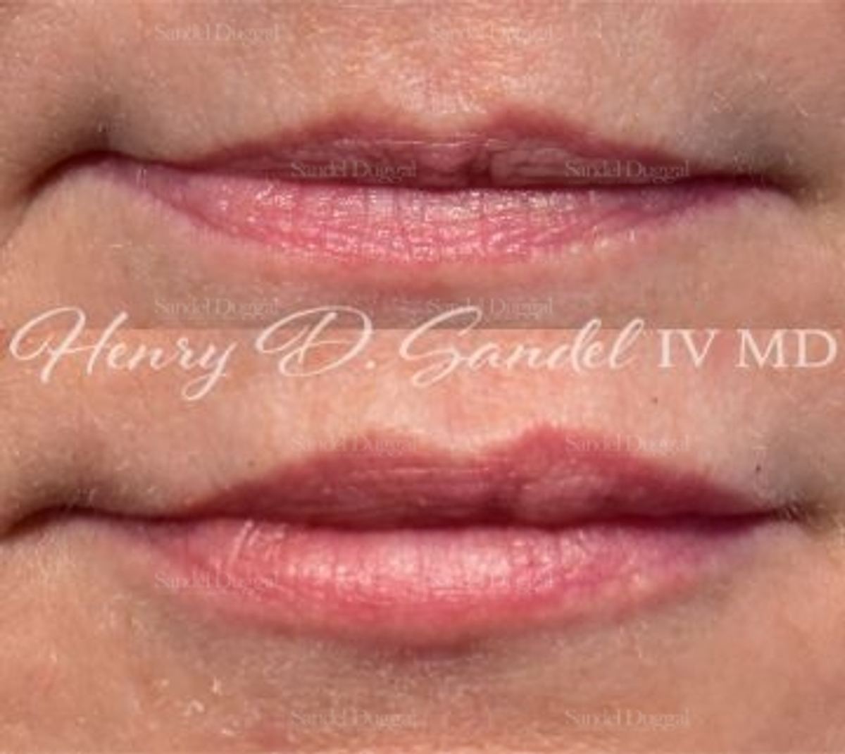 Lip Augmentation / Lip Lift before and after, case 4411