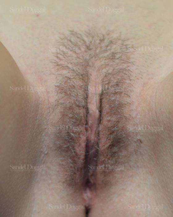 Labiaplasty after, case 3039