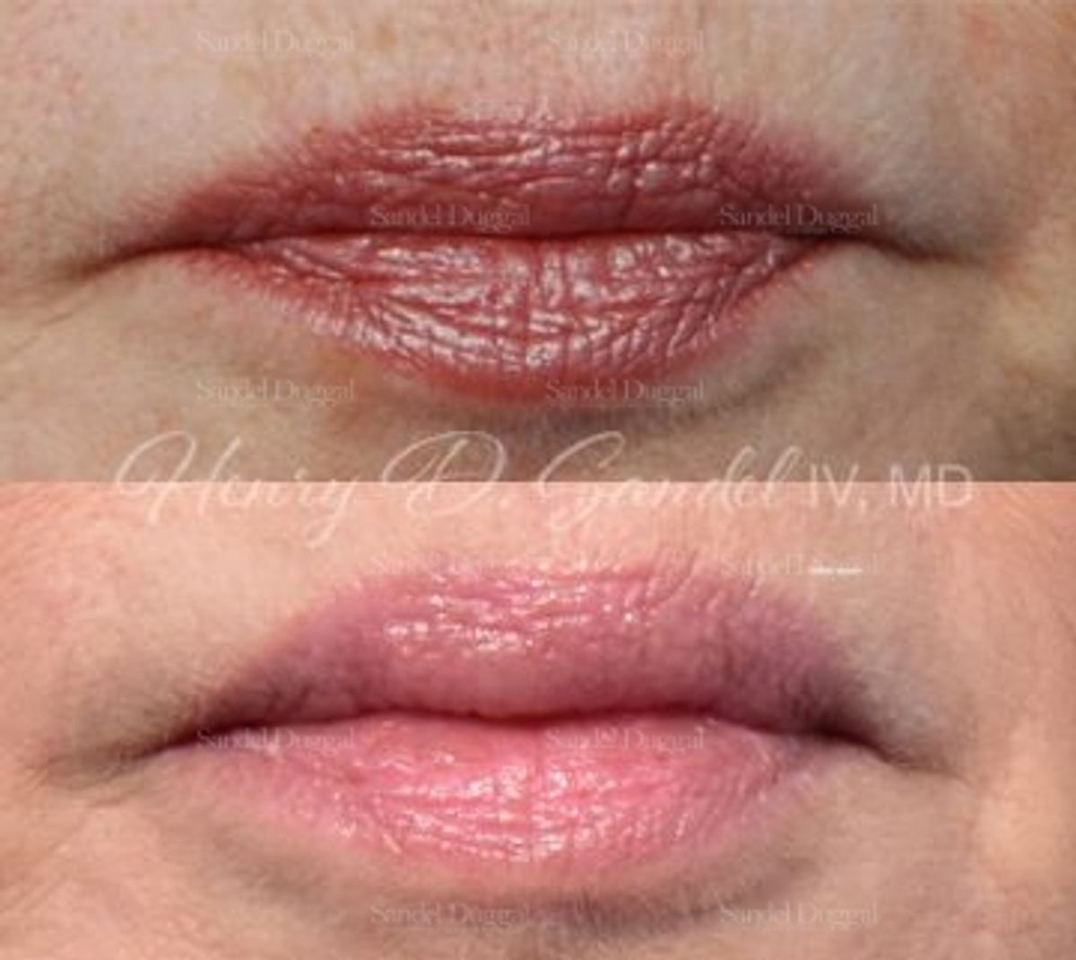 Lip Augmentation / Lip Lift before and after, case 4393