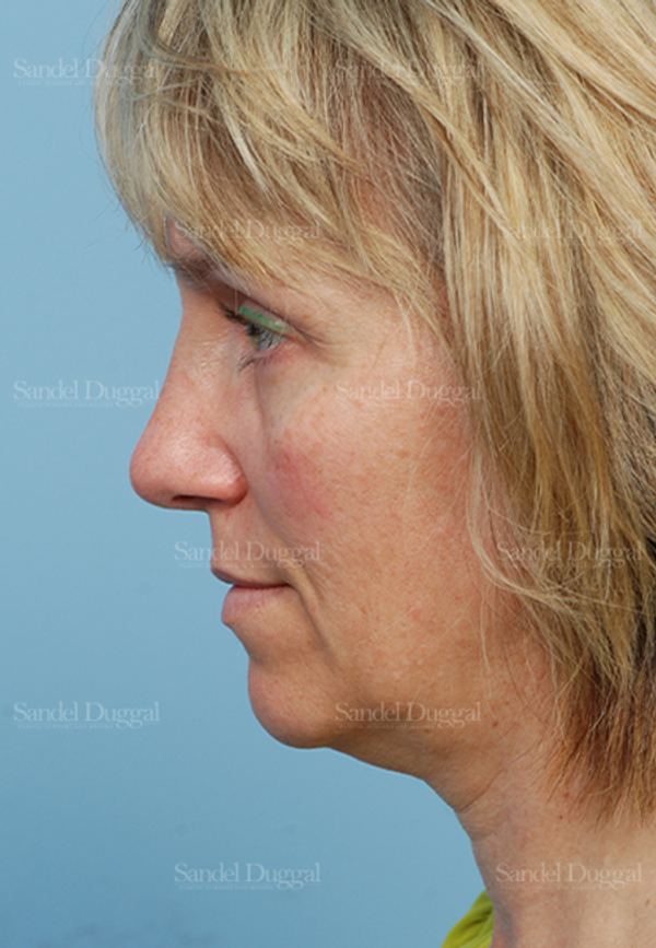 Rhinoplasty after, case 2855