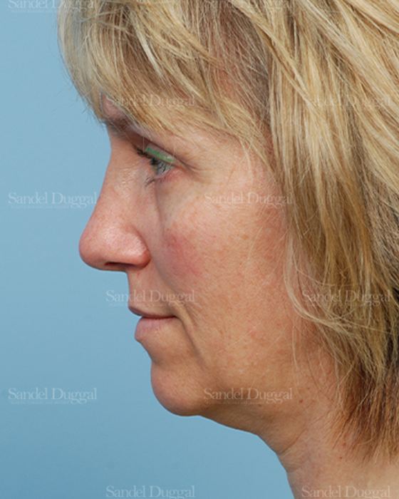 Rhinoplasty after, case 2855