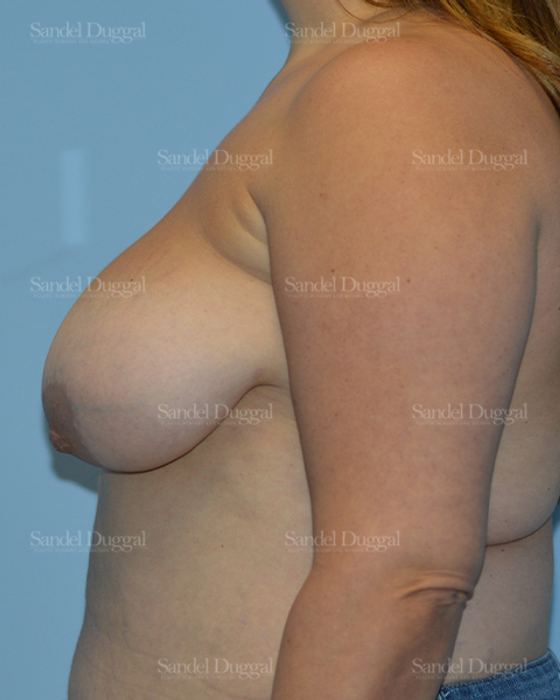 Breast Lift before, case 3280