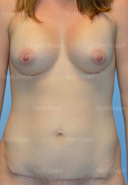 Mommy Makeover after, case 792