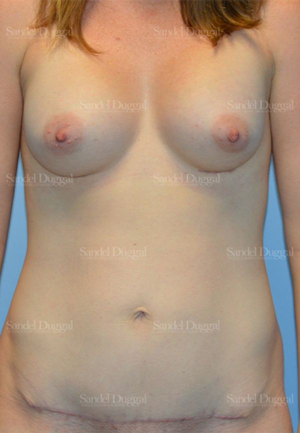 Mommy Makeover after, case 792