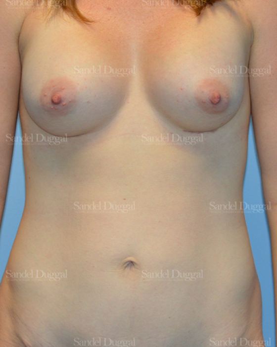 Mommy Makeover after, case 792
