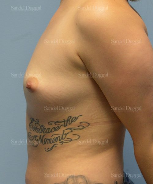Breast Augmentation before, case 3101