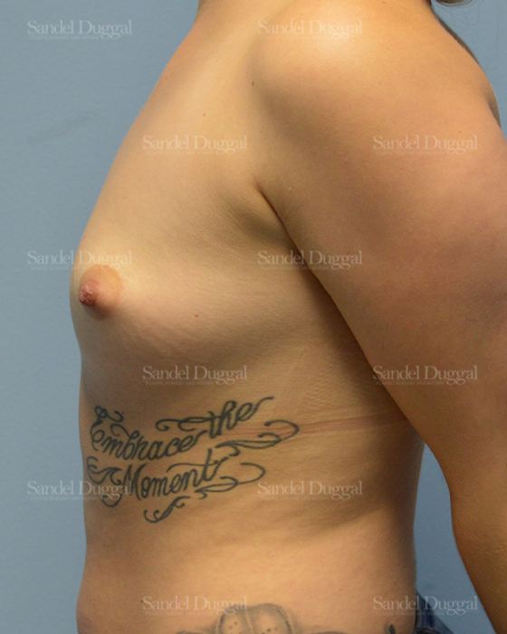 Breast Augmentation before, case 3101