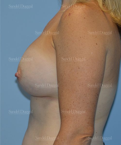 Breast Augmentation after, case 3192