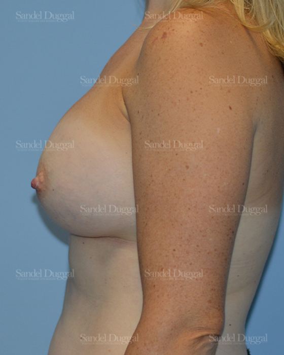 Breast Augmentation after, case 3192