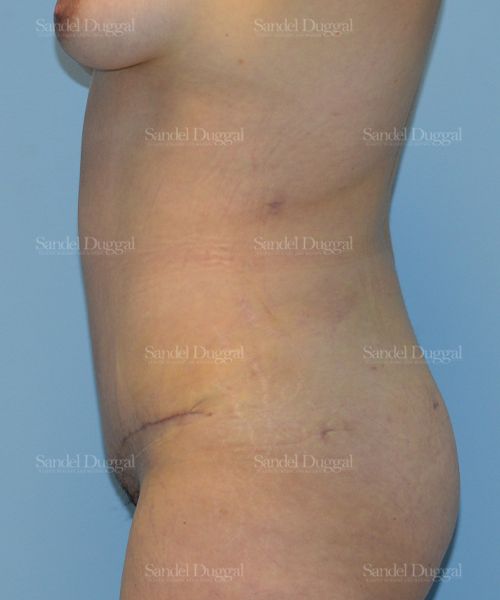 Tummy Tuck after, case 1643