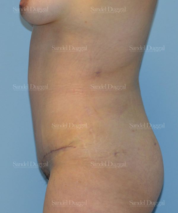 Tummy Tuck after, case 1643