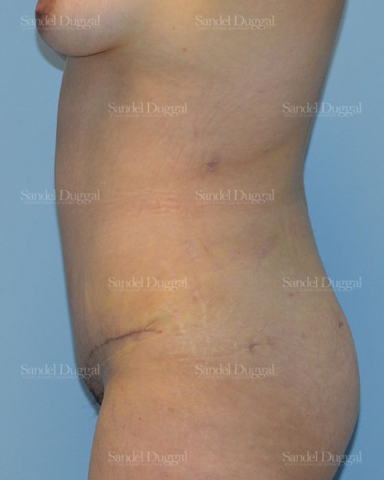 Tummy Tuck after, case 1643