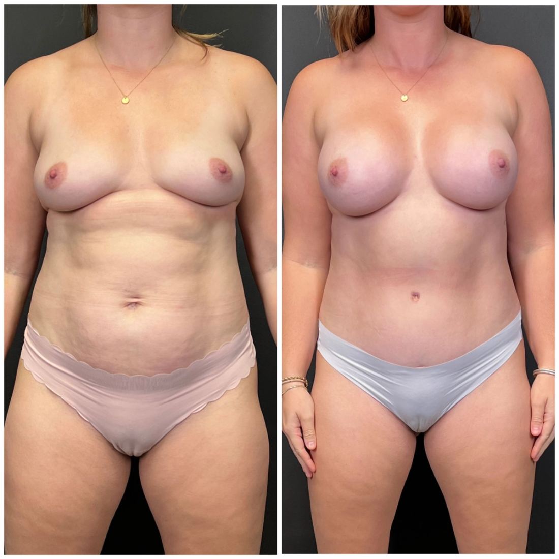 Mommy Makeover before and after, case mommy-makeover-07