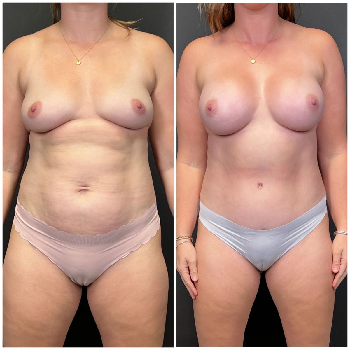 Mommy Makeover before and after