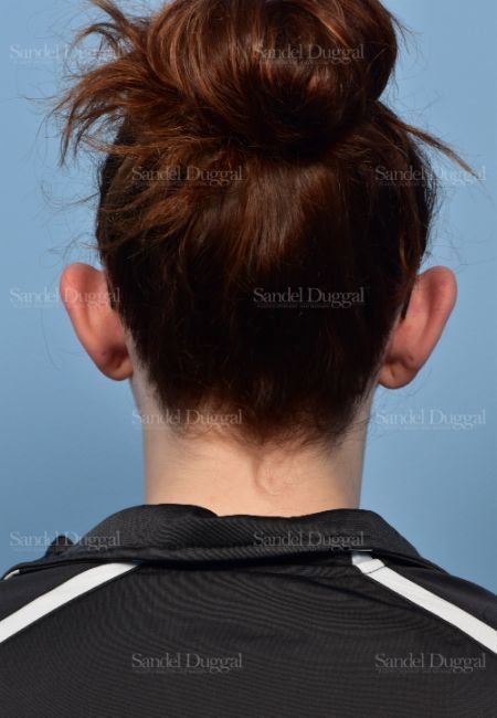 Otoplasty before, case 4073