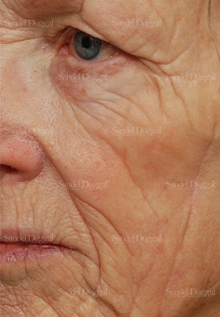Laser Skin Resurfacing before, case 2969