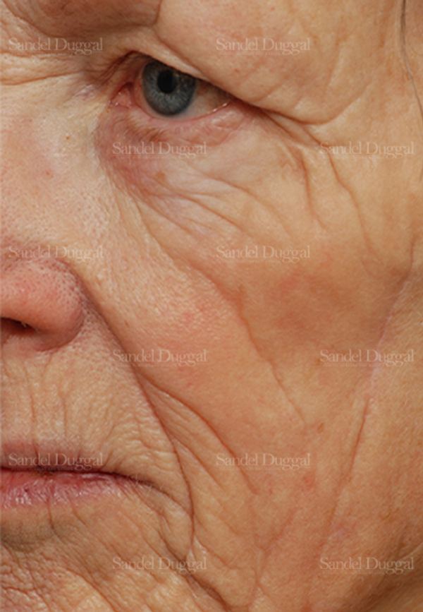 Laser Skin Resurfacing before, case 2969