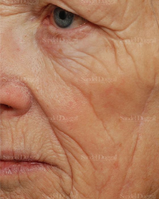 Laser Skin Resurfacing before, case 2969